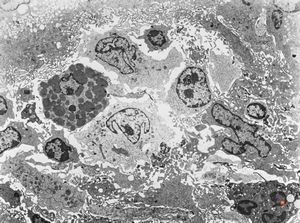 F,32y. | lymphadenopathy - clin. dysglobulinaemia F,32y. | lymphadenopathy - clin. dysglobulinaemia